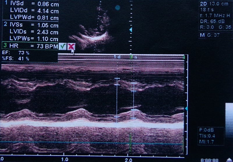 超声检查结果的彩色图像。用超声波机制造的。人类的心。耳间通讯(CIA)