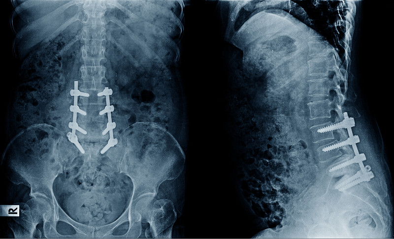 退行性腰椎间盘病减压及铁棒螺钉固定术后的腰椎x线影像