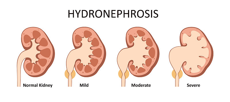 Hydro nephrosis stage.