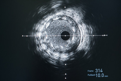 血管内超声成像(IVUS)