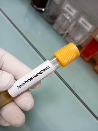 血液样本作血清蛋白电泳(SPEP)试验。医学概念疾病研究