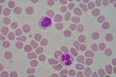 Neutrophil&lymphocyte