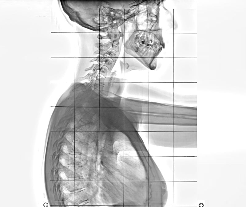胸部和脊柱x光片，侧视图