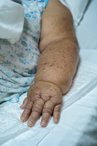 老年女性乳腺癌腋窝排空所致淋巴水肿