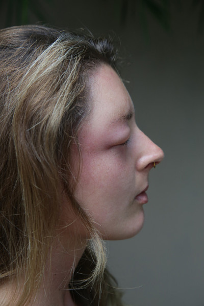 年轻的白种女人眼睛被黄蜂刺肿了。黄蜂叮咬后的过敏反应。
