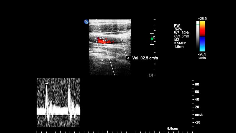 血管超声检查。