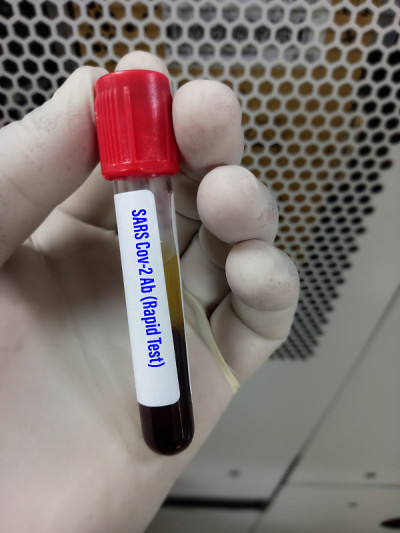 SARS Cov 2抗体检测，血样试管进行COVID-19快速抗体检测，接种后进行