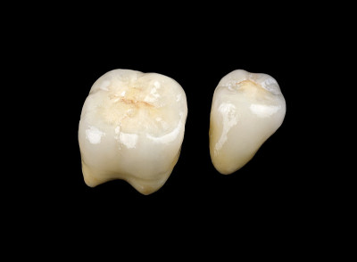 陶瓷冠
