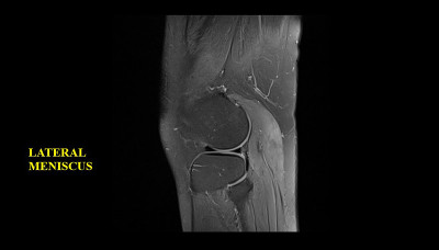 膝关节MRI(磁共振成像)