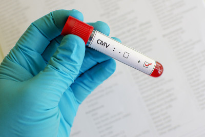 巨细胞病毒(CMV)阳性