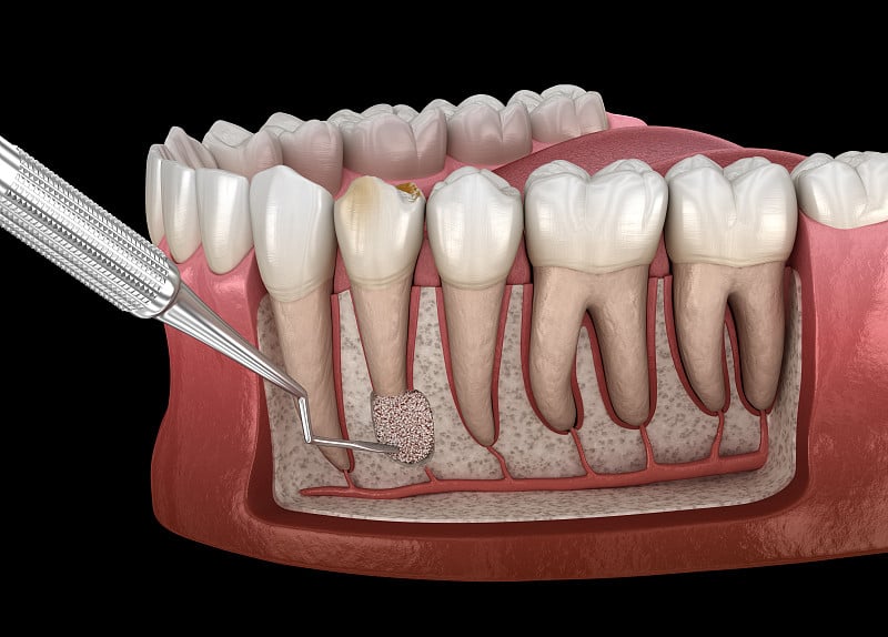 牙囊切除术-骨膜炎后的恢复。医学精准3D插图