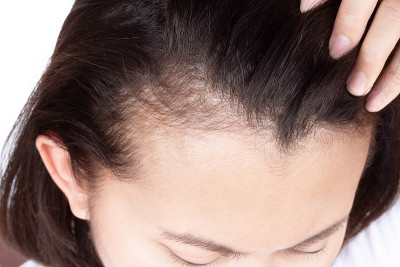 女性严重的脱发问题为保健洗发水和美容产品的概念，选择性的重点