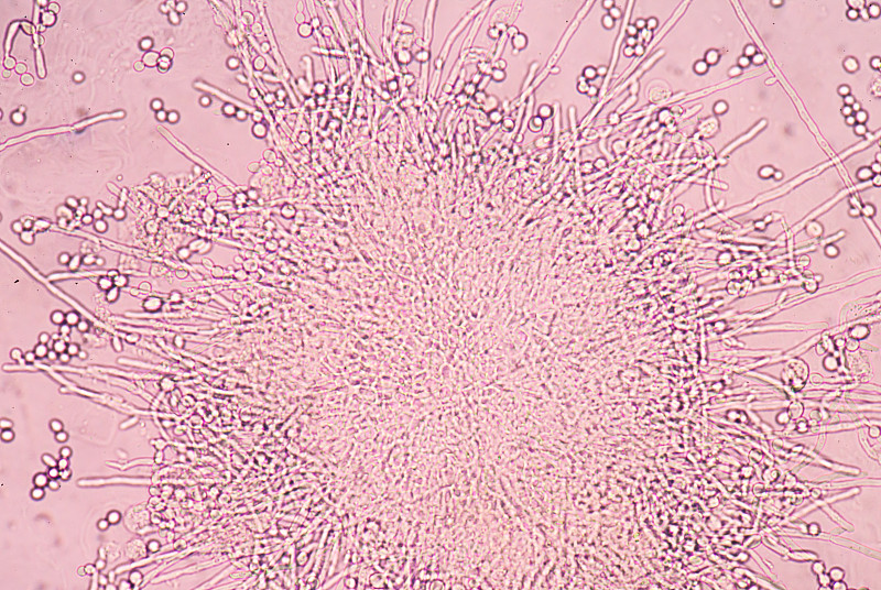 尿液样本中带有假菌丝的芽殖酵母细胞