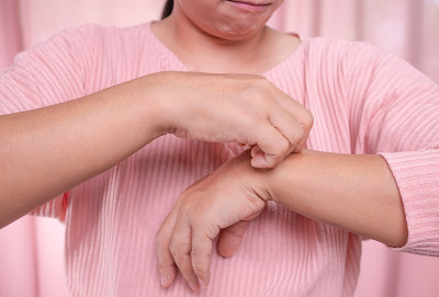 中年妇女因皮肤干燥发痒、湿疹、皮炎、过敏、牛皮癣，在手臂上抓挠痒痒。保健与皮肤病概念。
