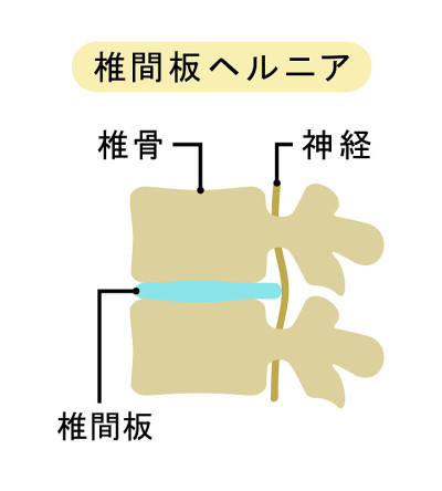 椎间盘突出