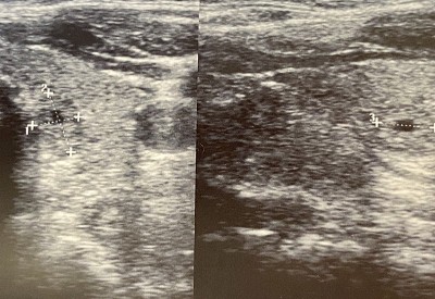 甲状腺结节超声检查