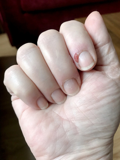 患有手指感染疾病者。指甲的痛苦。