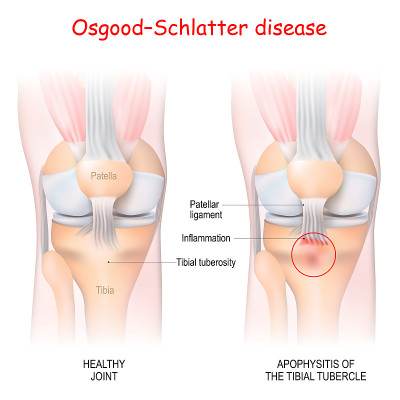 Osgood-Schlatter疾病。健康的关节和胫骨结节的隆起炎。
