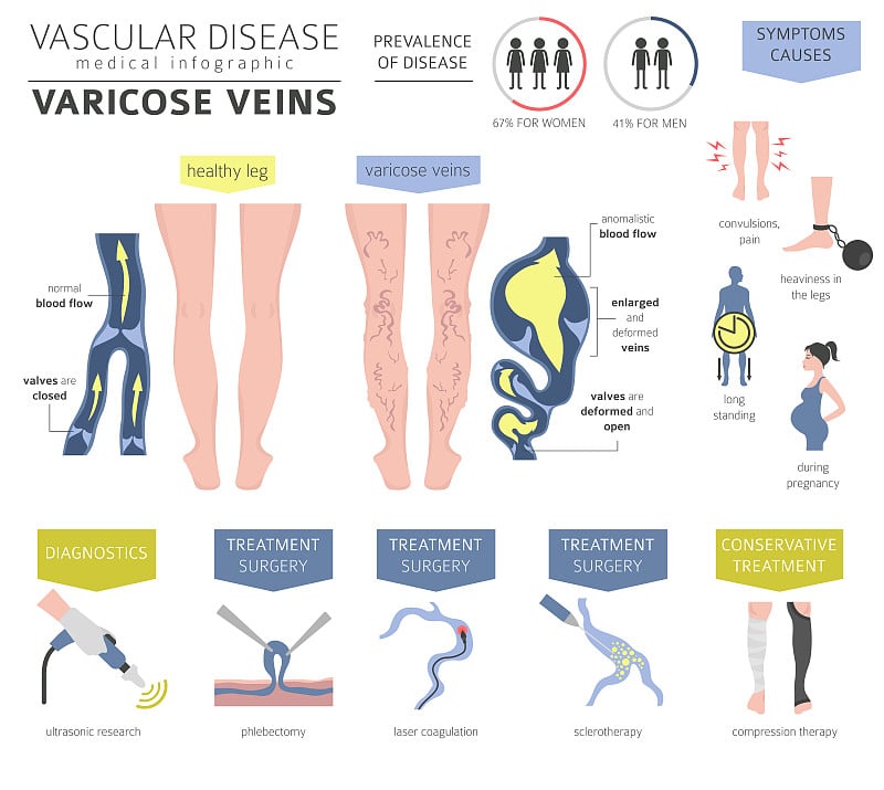 血管疾病。静脉曲张症状，治疗图标设置。医疗信息图表设计
