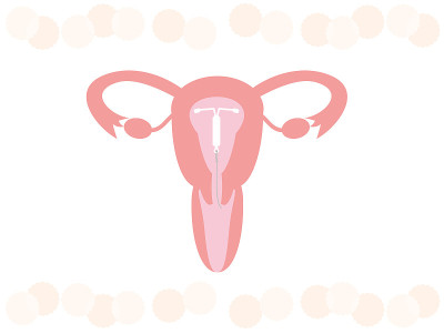 图示宫内节育器(IUD)。