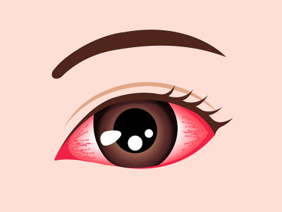 结膜炎(红眼)病媒说明