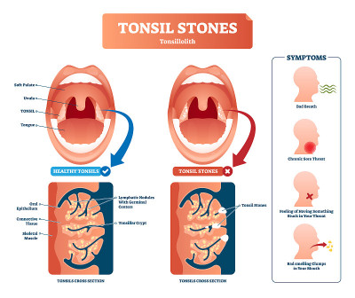 Tonsil stones vector illustration. Labeled medical
