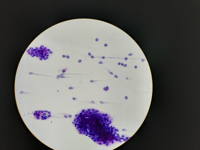 胸膜液腺癌
