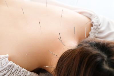 在一个明亮的针灸诊所里，一个女人背上插着一根针