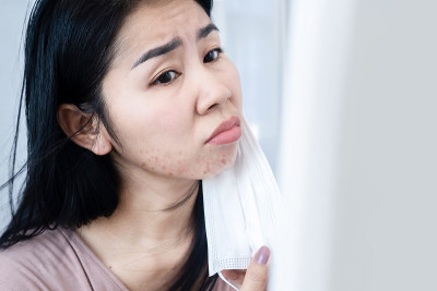 亚洲妇女有痤疮和皮疹的皮肤过敏下下巴和脸因为保护面膜