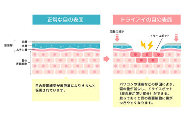 Comparison illustration between normal and dry eye