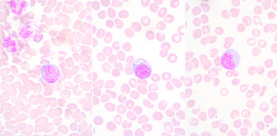 非典型lmphocyte