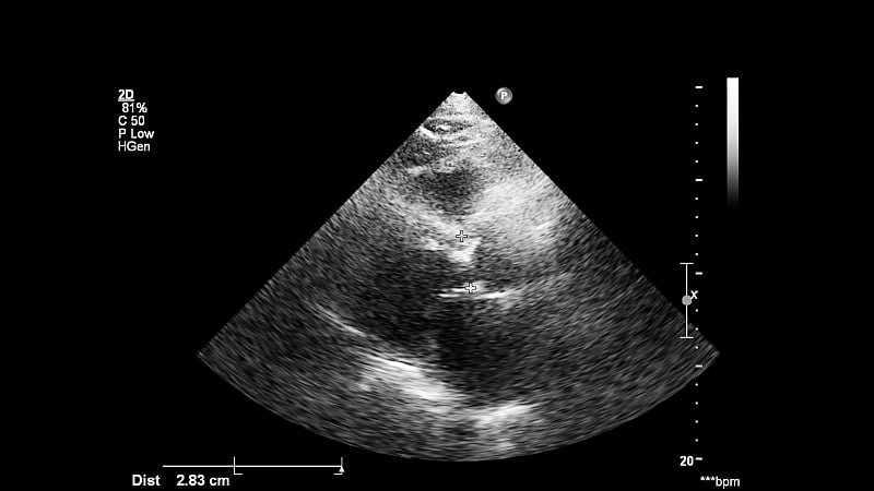 经食管超声检查心脏图像。