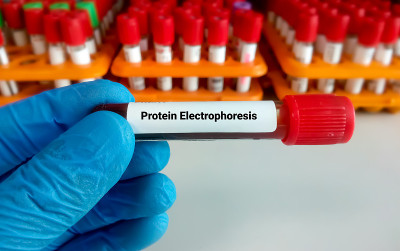 有实验室背景的血液样本进行蛋白质电泳检测。疾病的科学概念、实验室和研究。关闭了。