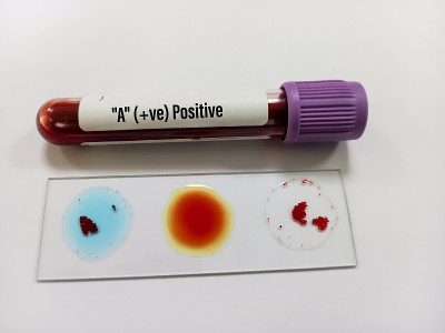 用玻片凝集法对样本进行血型检测，A型阳性。医学的概念