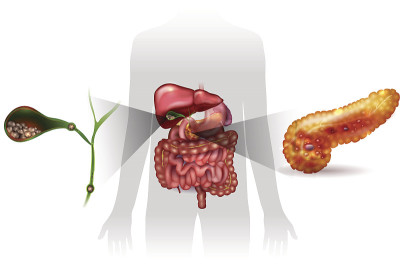 胆结石和急性胰腺炎
