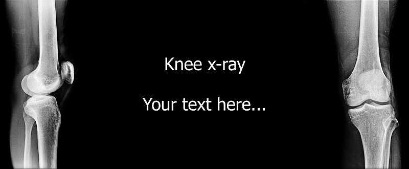 膝盖前方的x光图像，侧视图，文字“膝盖x光”，“你的文字在这里……'可以擦除空白，以添加其他文本