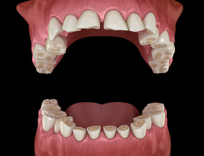 牙齿磨蚀(磨牙症)导致牙齿组织的缺失。医学上准确的牙齿3D插图