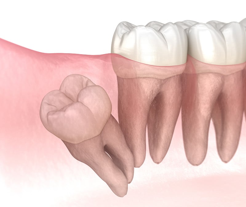 智齿远端嵌顿。医学上准确的牙齿3D插图
