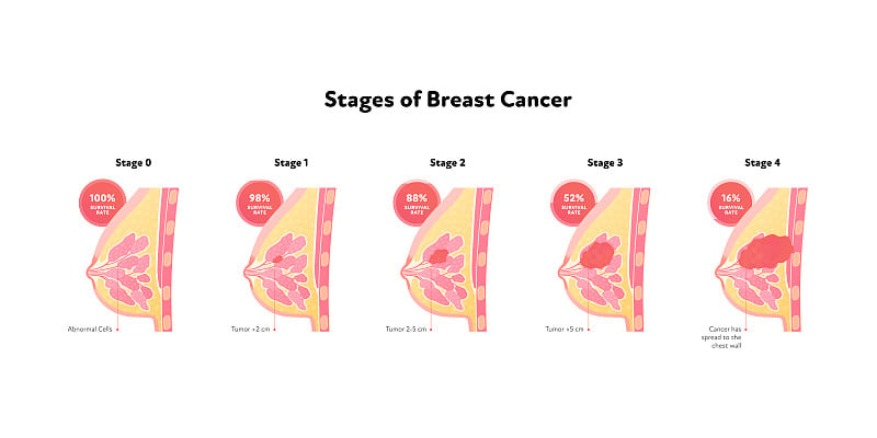 人类乳腺癌解剖图。矢量平面医学插图。侧视图。存活率。在白色背景上分离的肿瘤分期。为医疗保健、教育、肿