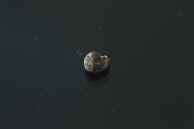 草酸钙肾结石