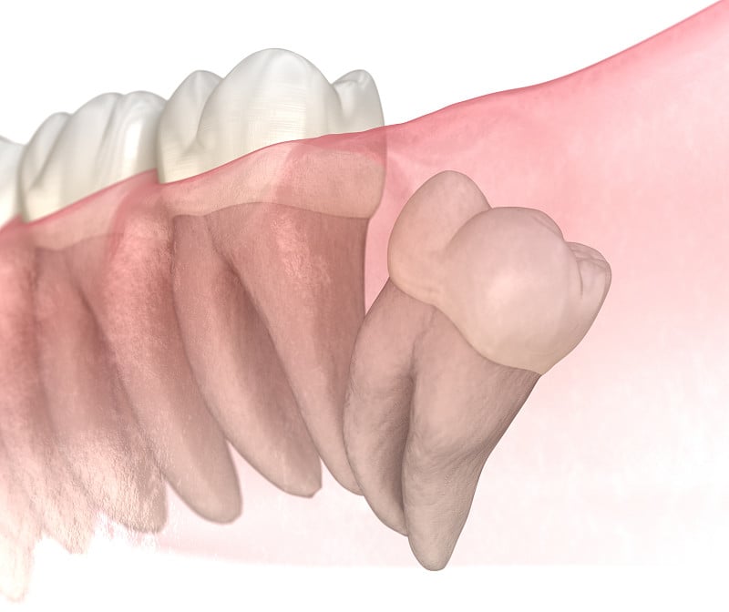 智齿远端嵌顿。医学上准确的牙齿3D插图
