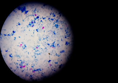 痰涂片AFB染色显微镜近距离观察。Macrobacterium肺结核细菌。本空间