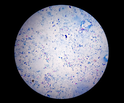 痰涂片AFB染色显微镜近距离观察。Macrobacterium肺结核细菌