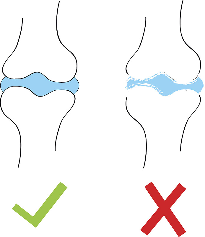 关节有软骨和关节炎。矢量插图。