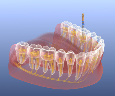 根管治疗过程。医学上准确的牙齿3D插图。