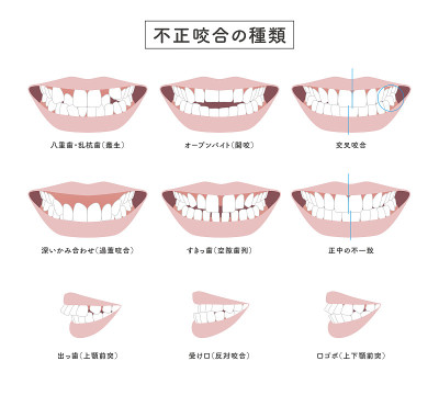 错牙合型插图