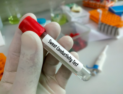 科学家或生物学家拿有样品的试管进行汗液传导测试。囊性纤维化的诊断。