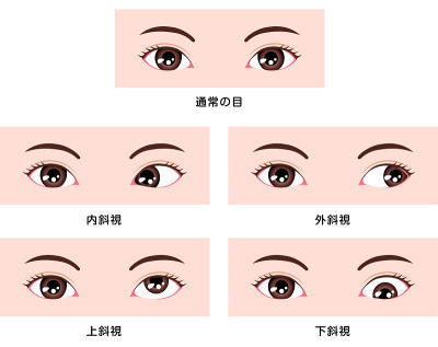 斜视类型矢量图