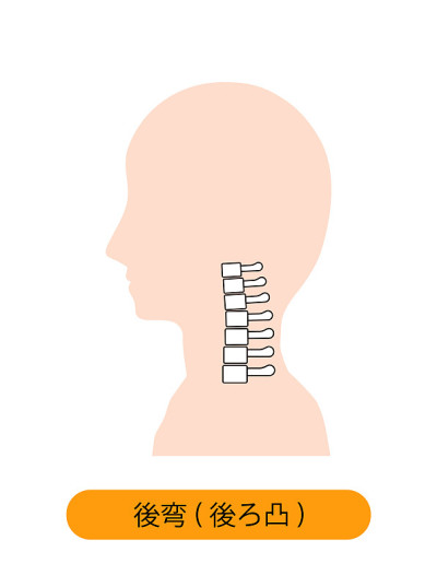 这是伴有颈椎后凸的颈骨的图示。