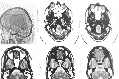 头颅CT和MRI